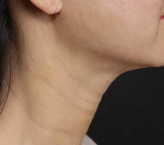 목주름 시술 후 사진