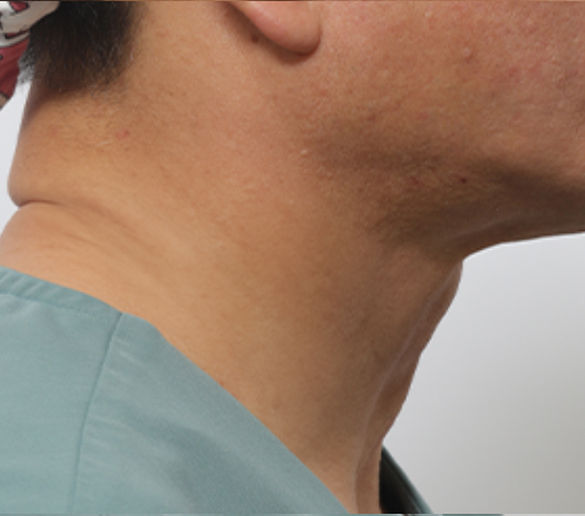 목·턱선 시술 후 사진