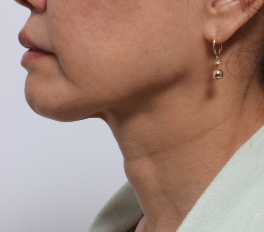 목·데콜테 시술 후 사진