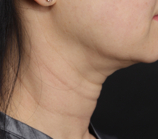목주름 시술 전 사진
