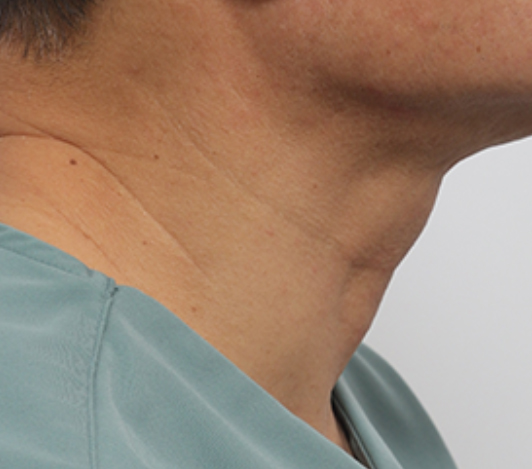 목·턱선 시술 전 사진