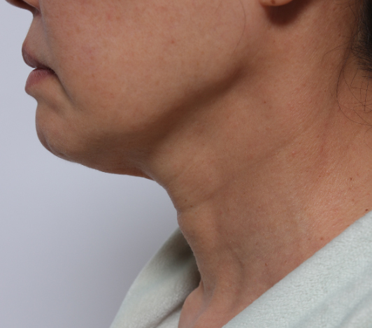 목·데콜테 시술 전 사진