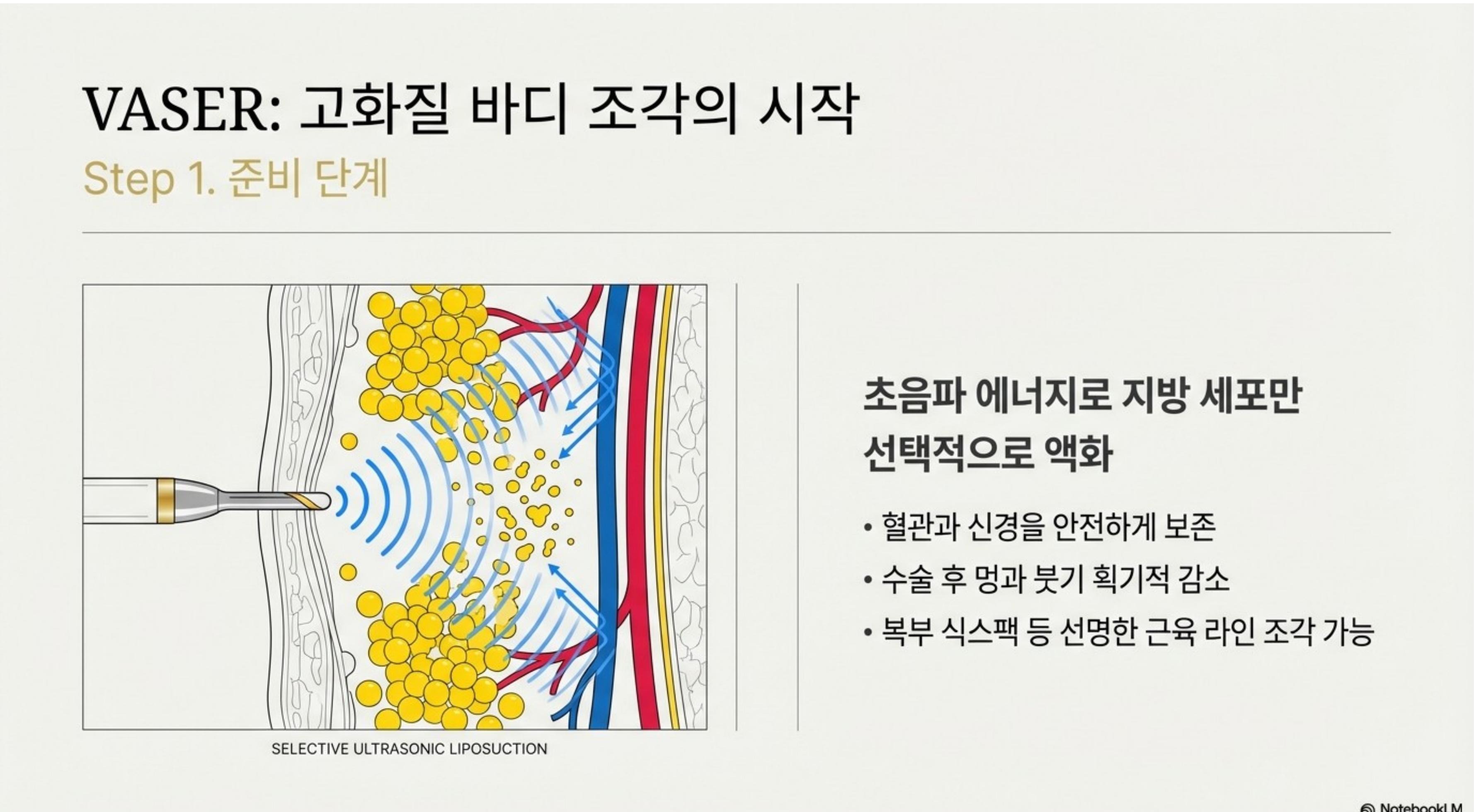 VASER: 고화질 바디 조각의 시작 — Step 1 준비 단계, 초음파 에너지로 지방만 액화, 혈관과 신경 안전 보존