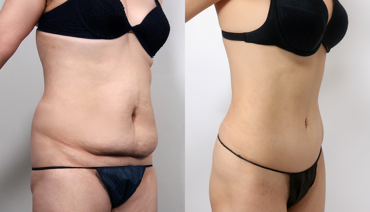 30대 복부성형 전후 - 출산 후 늘어난 뱃살 및 복근이개 교정