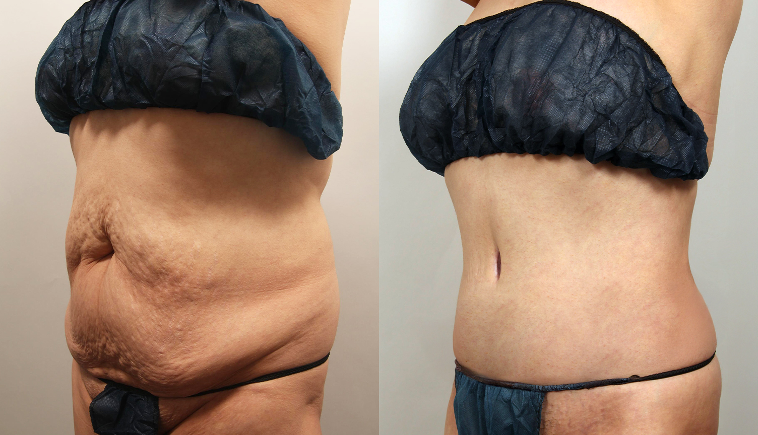 30대 중반 복부성형 전후 - 복근이개 복원 및 배 모양 교정