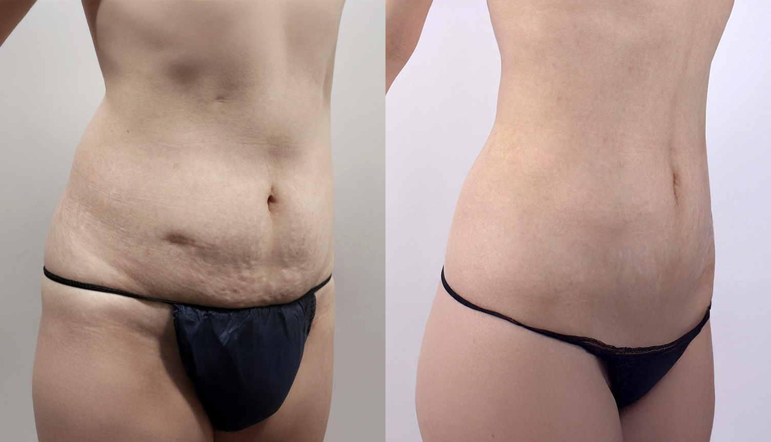 40대 초반 리뉴비온 미니 복부 타이트닝 전후