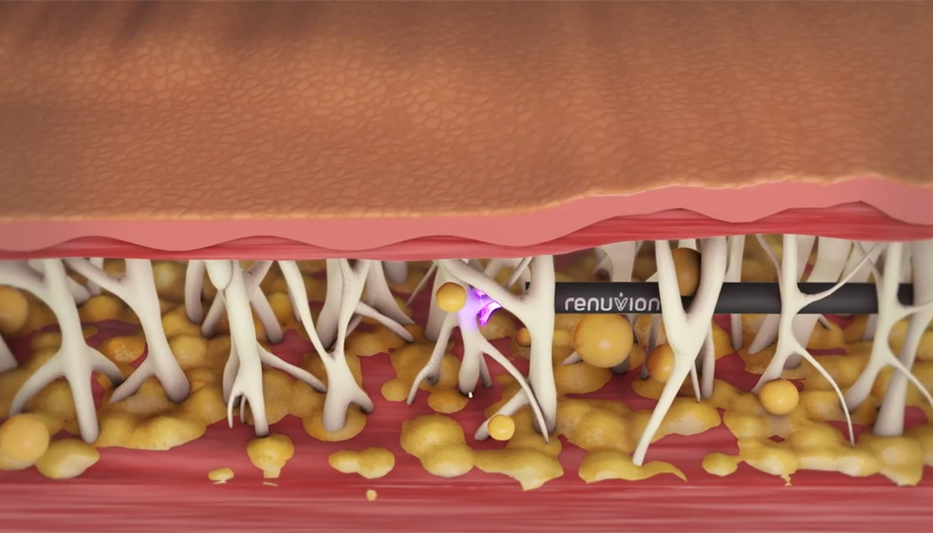 리뉴비온 미니 복부 타이트닝 시술