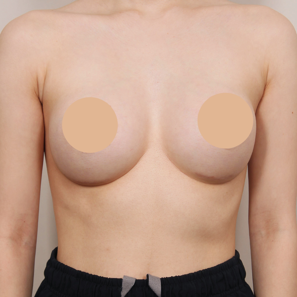 4D 가슴성형 후 사례 4