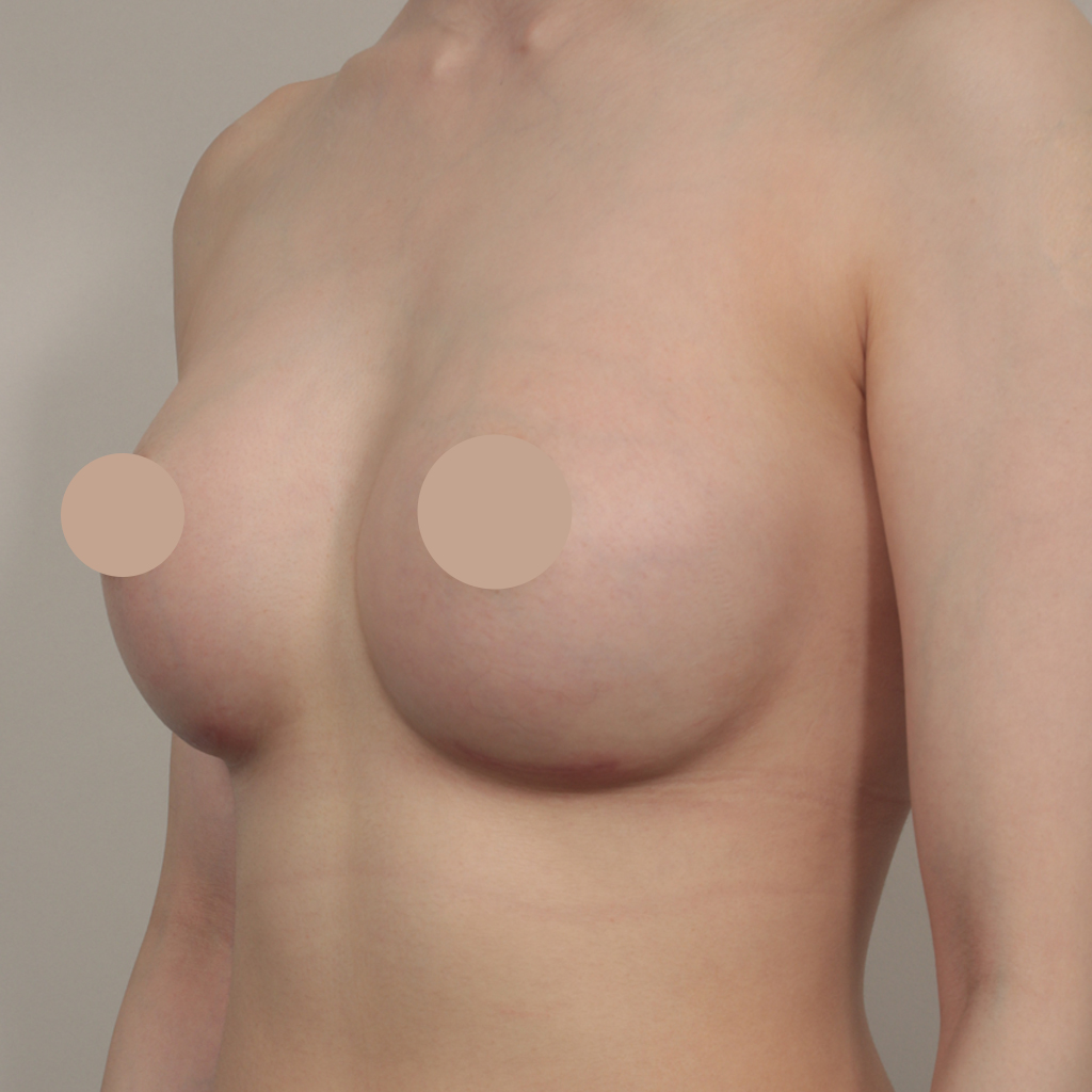 4D 가슴성형 후 사례 5