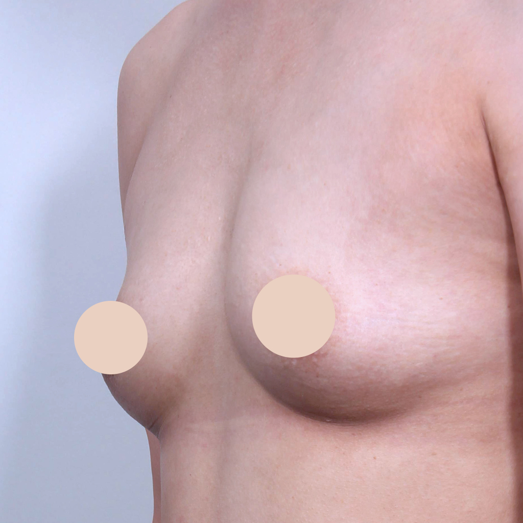 Case 02 수술 전 (참고)